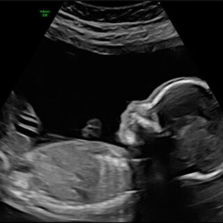 De 20 weken echo voor tweelingen bij Goud echo en prenatale screening in Kampen, Ermelo, Almere en Lelystad
