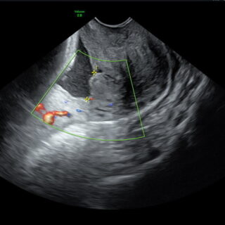 Placentalokalisatie om de ligging van de placenta te bepalen